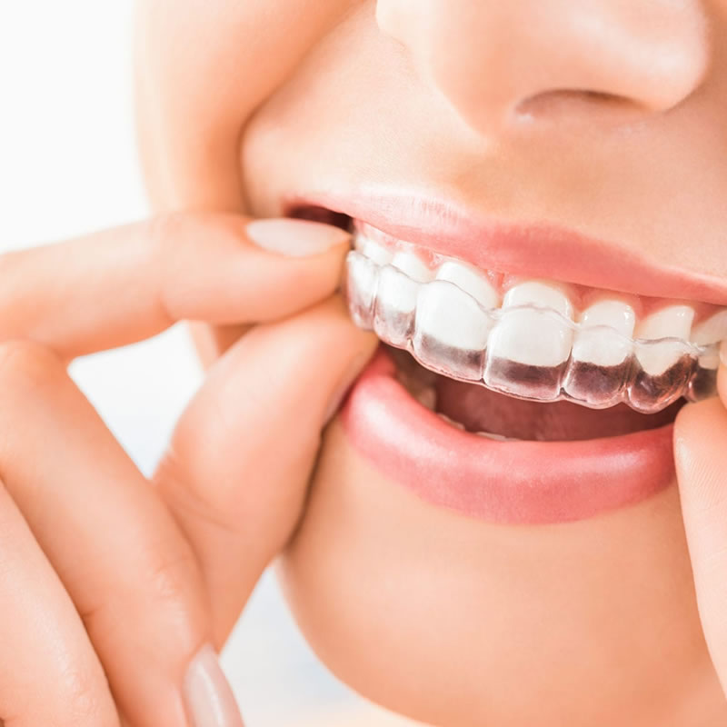 Which Is Better Braces Or Invisalign?